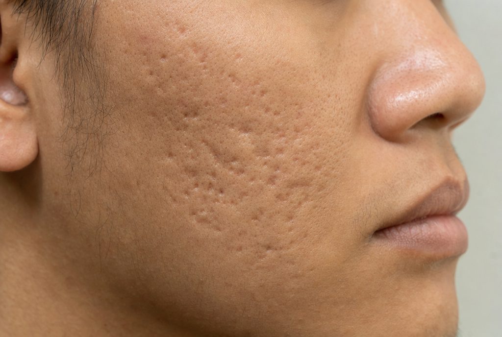 AI-generated illustration of acne scarring on the cheek