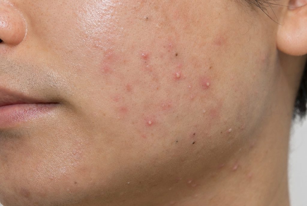 AI-generated illustration of active acne on the cheek and jawline