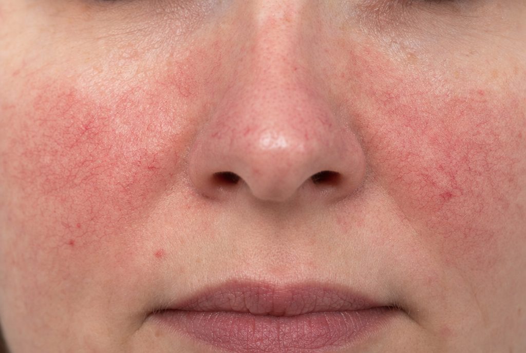 AI-generated illustration of rosacea redness across the cheeks and nose