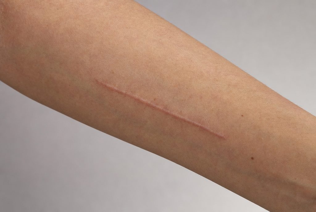 AI-generated illustration of a healed linear scar on the forearm