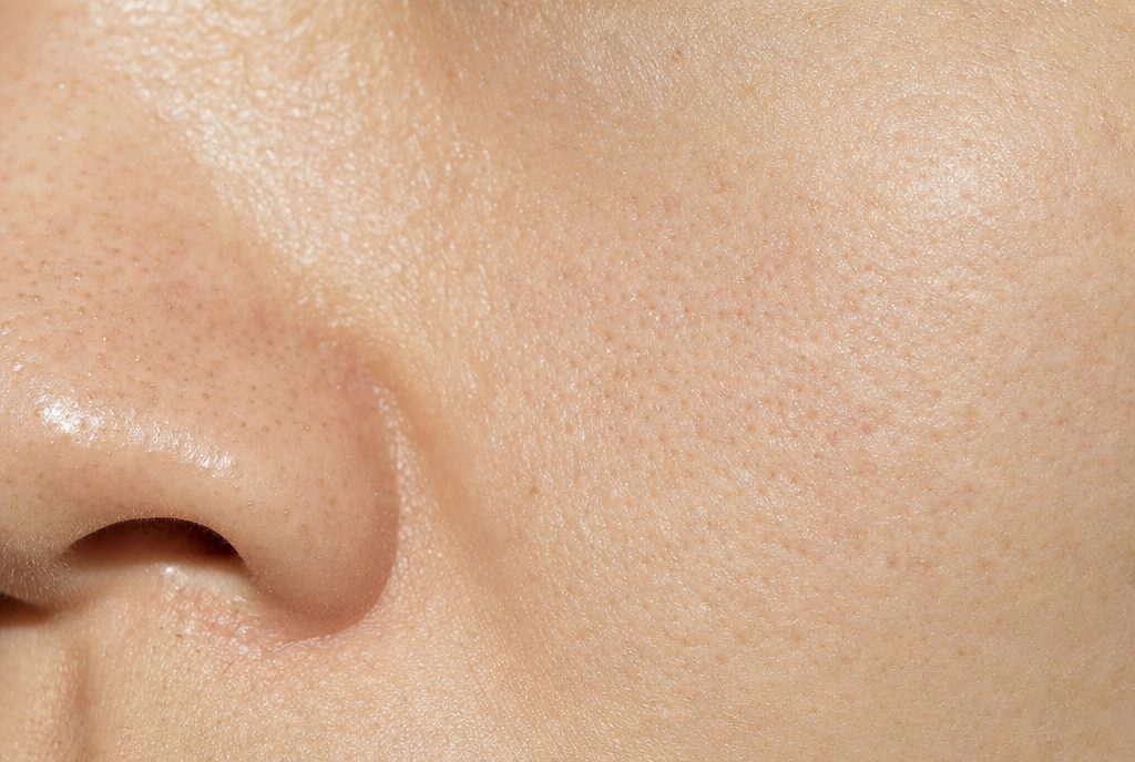 AI-generated illustration of enlarged pores beside the nose