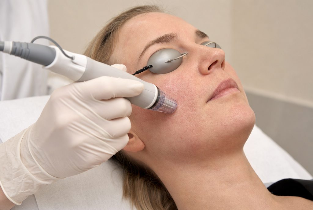 Illustrative image of a radiofrequency microneedling treatment (AI-generated).