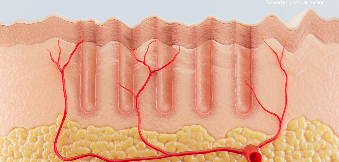 Illustration of the fine channels a fractional laser creates in the skin